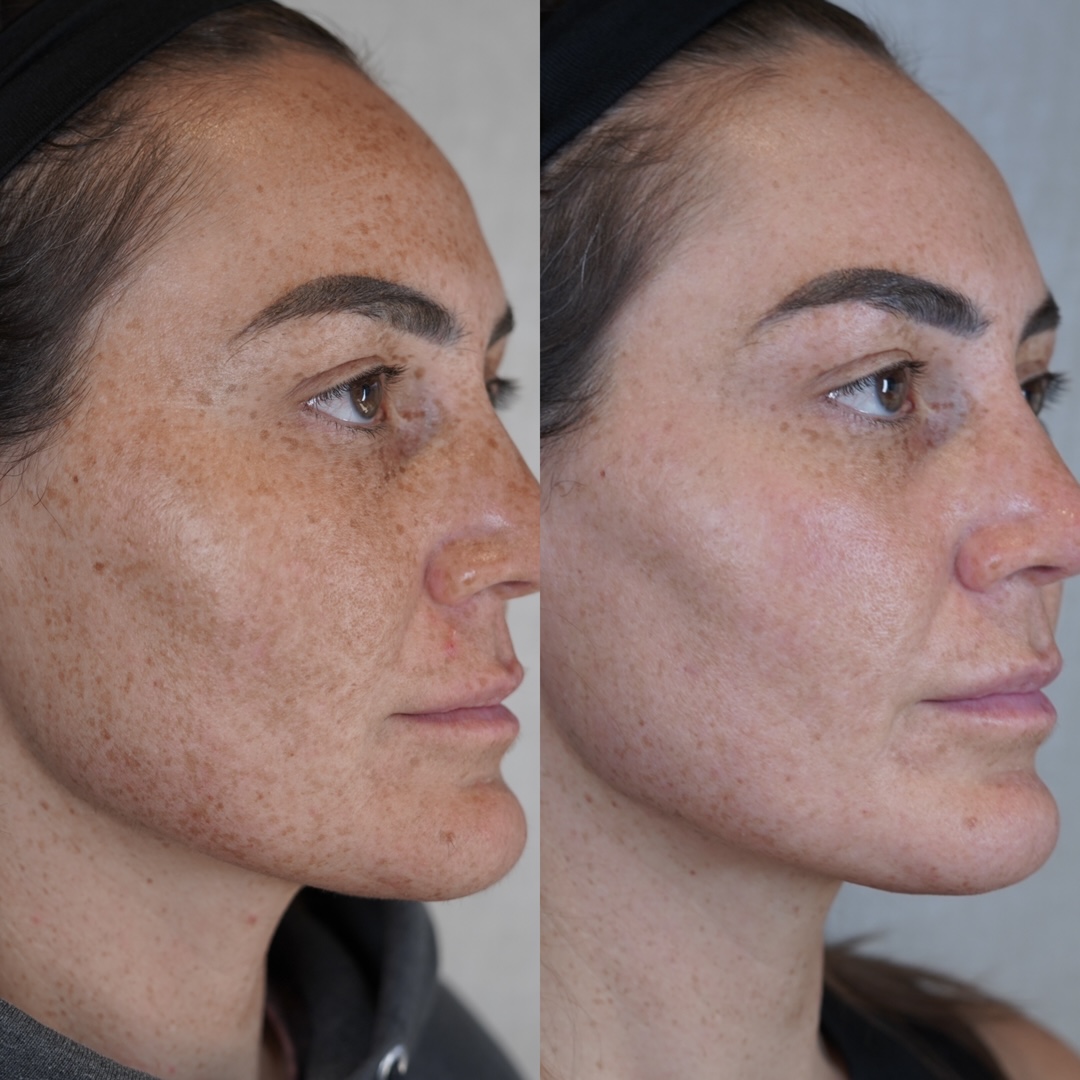 BBL before and after results - freckle and sun spot reduction