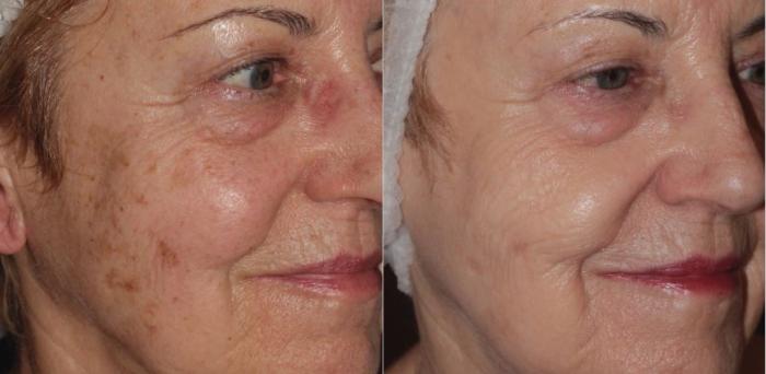 BBL before and after results - facial pigmentation improvement
