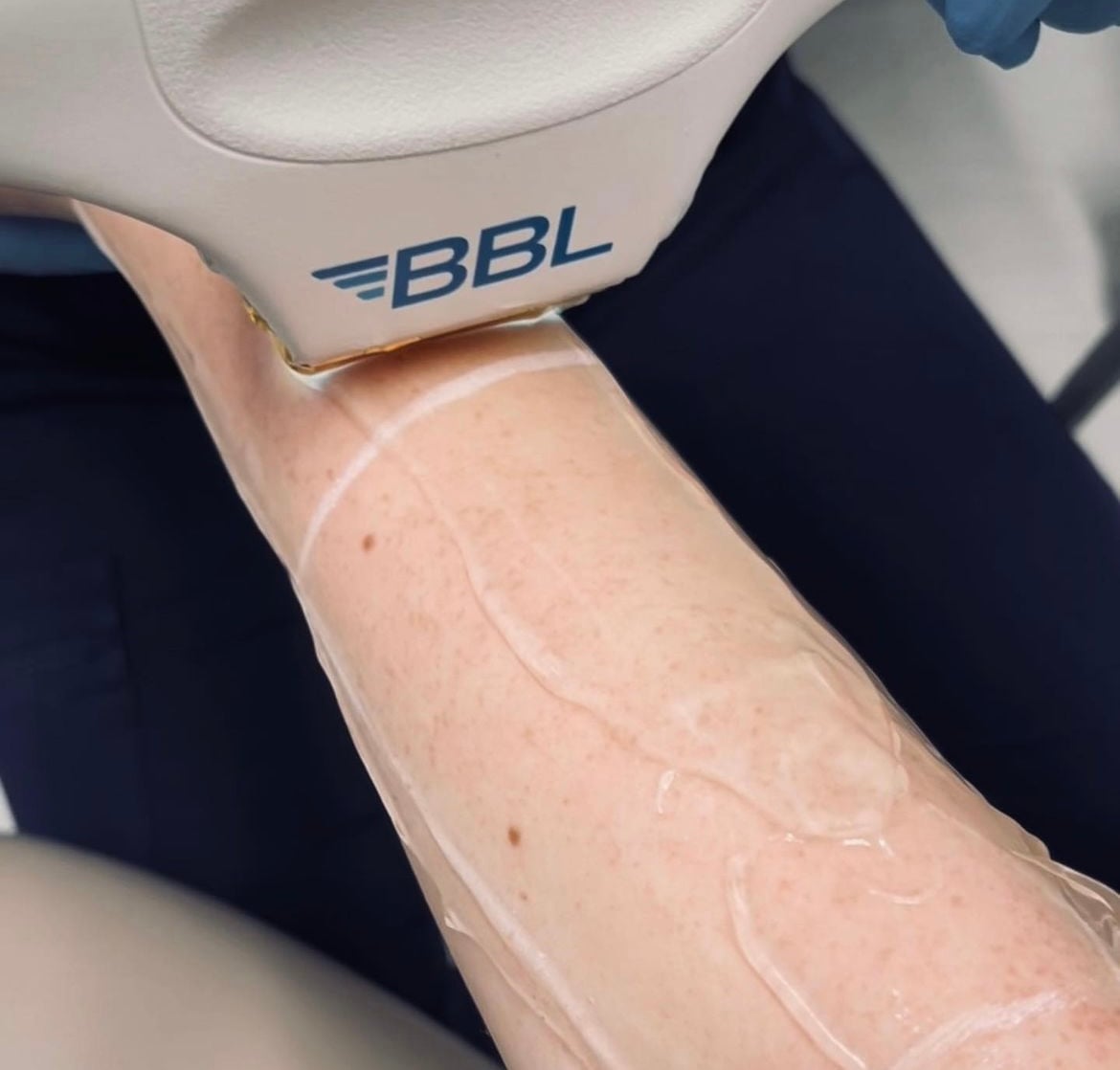 BBL BroadBand Light handpiece delivering treatment to skin at Be Clinical