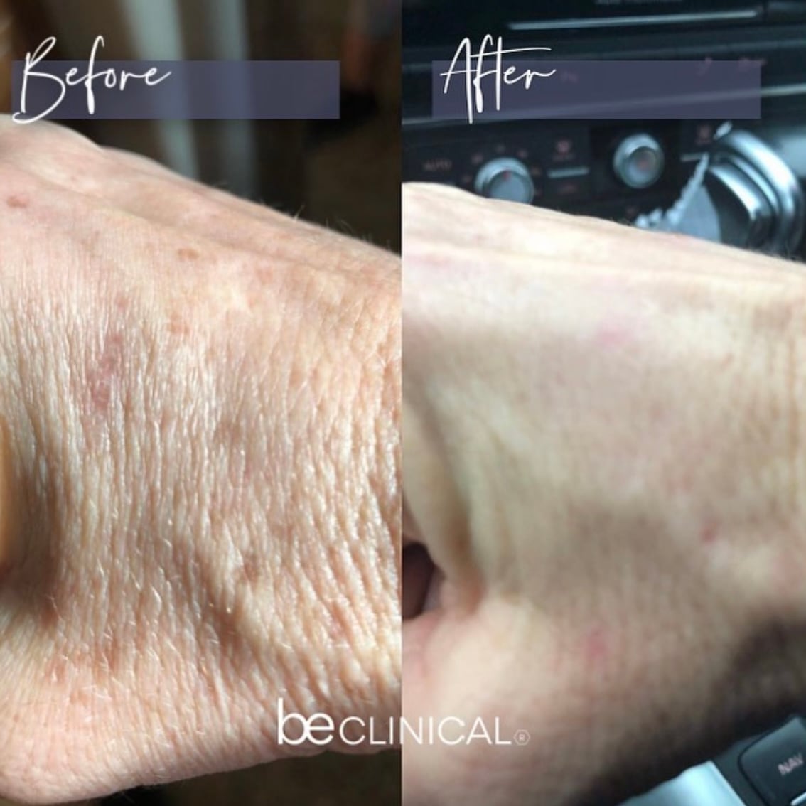 BBL Forever Young before and after results - hand rejuvenation and sun spot removal