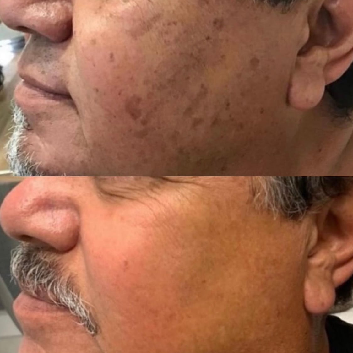 BBL Forever Young before and after results - facial sun spot and pigmentation reduction