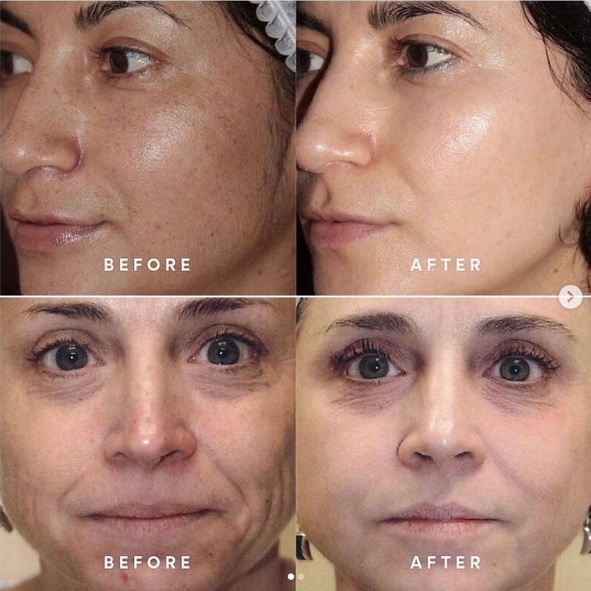 BBL Forever Young before and after results - full face skin rejuvenation