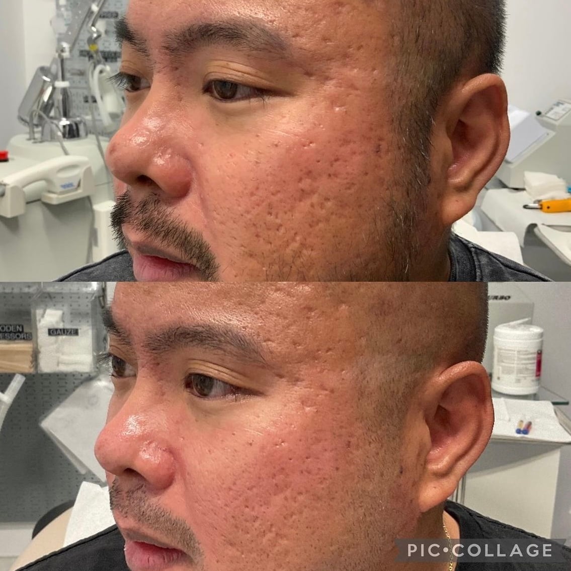 BBL Forever Young before and after results - acne scar and skin texture improvement